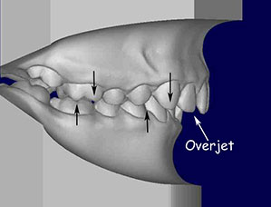 Model showing a class 1 malocclusion