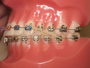 Class 2 rubber bands for braces to correct an overbite