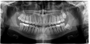 Panoramic x-ray taken prior to braces