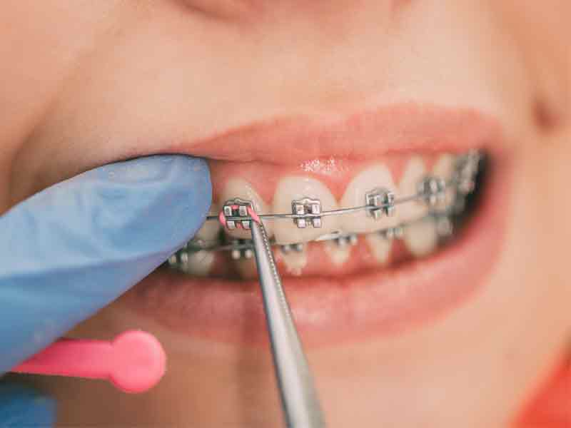 Colored tie being placed on braces